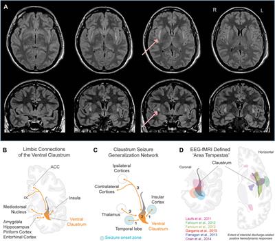 Is there room in epilepsy for the claustrum?